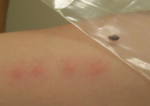 ... nightmares regularly, then wake up with these bites all over my body